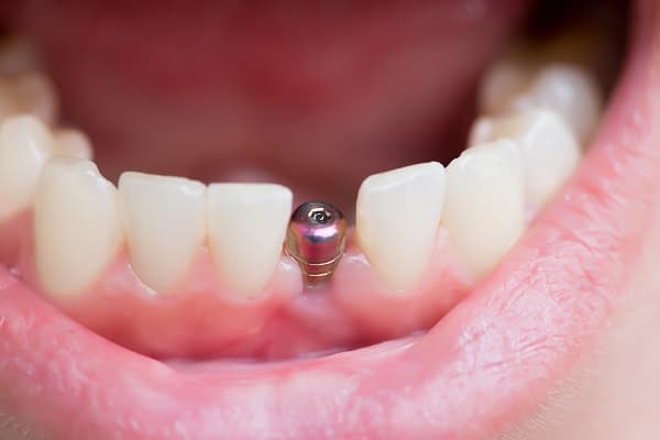 Dental Implants Smile
